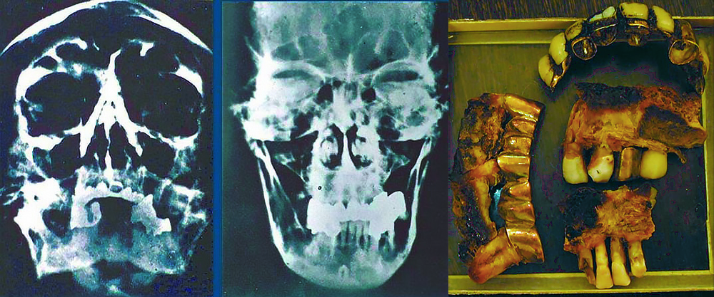 Фото: ФСБ РФ, Mark Benecke / Forensic Dental Evidence (Elsevier)